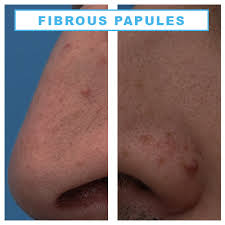 Asymmetry, border, color, diameter, elevation. I Have A Spot Or Bump On The Nose What Could It Be Dr Sajjad Rajpar