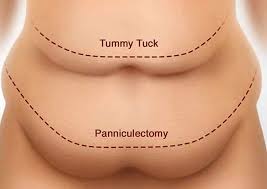 Check spelling or type a new query. Panniculectomy Procedure Recovery Panniculectomy Complications