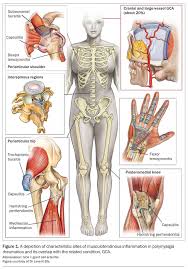 Image result for Polymyalgia Rheumatica