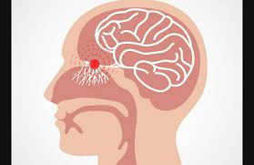 14 видео 365 просмотров обновлен 25 февр. Anosmia Merupakan Gejala Sangat Khas Covid 19 Portal Kabupaten Probolinggo