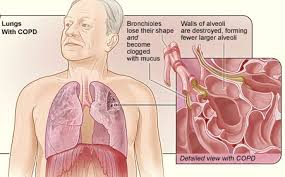 Emphysema and chronic bronchitis are two forms of chronic obstructive pulmonary disease (copd). Emphysema Vs Copd Science Class 2021 Study Com