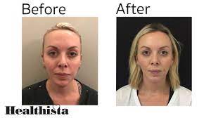 7 weeks post prf for under eye hollows. The Dark Circles Treatment That Transformed My Tired Eyes Healthista