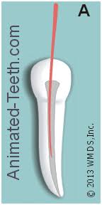 Root canal treatment is preferred when the infection has reached the vital tissue i.e the pulp and has infected the pulp tissue, it is also recommended when the tooth has lost its vitality (died). The Root Canal Procedure What Are The Steps Of The Process What S It Like To Have Treatment