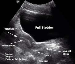 Check spelling or type a new query. Gynecology Pelvic Ultrasound Made Easy Step By Step Guide Pocus 101