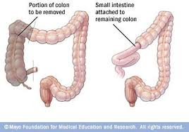 Pin On Colon Cancer