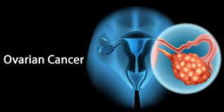 How is ovarian cancer diagnosed? How Much Do You Know About Ovarian Cancer Emabal Hospitals Limited