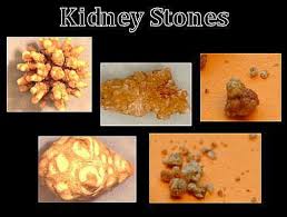 Different Types If Stones Kidney Stones Kidney Stones Remedy Natural Home Remedies