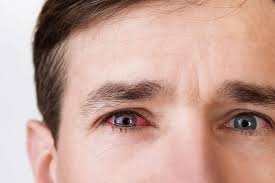 Image result for Conjunctivitis