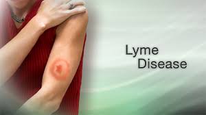 Lyme Disease Information Mount Sinai New York