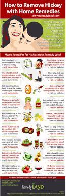 How To Remove Hickey Fast With Home Remedies - Remedy Land