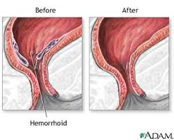 Image result for hemoroid human
