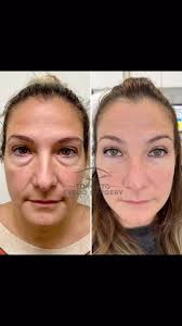 I saw this lovely patient of mine 1 year ago because she was bothered by  her eye bags, skin laxity and hyperpigmentation of her skin. She underwent:  , Bilateral transconjunctival lower lid ...