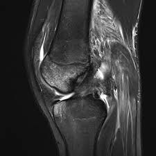 Support your knee after a mild hyperextension injury. Hyperextension Knee Injury Radiology Case Radiopaedia Org