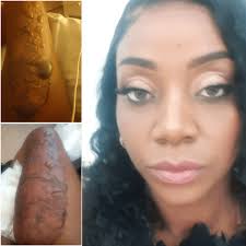 Nancy raakte ernstig verbrand door het gebruik van een kruik.