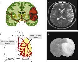 Brain Ischemia And Reperfusion Cellular And Molecular Mechanisms In Stroke Injury Sciencedirect