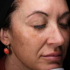 Image result for Melasma