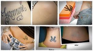 Step By Step Natural Tattoo Removal How To Remove Tattoos At Home Naturally Natural Tattoo Removal Tattoo Removal Cost Tattoo Removal