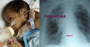 Sekiranya anda mengalami batuk dengan kahak berdarah, jangan ambil ringan. Anak Batuk Kahak Tanpa Henti Disahkan Pneumonia Gara Gara Asap Rokok Pa Ma
