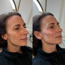 A little lift goes a long way ✨ By restoring volume only in the cheeks, we  naturally lift the mid-face, soften the under-eye area, and enhance facial  contours — all without changing