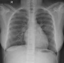 These bones give the neck structure, support the skull, and protect the spinal cord, among other functions. Sickle Cell Disease Hip Avascular Necrosis And H Shaped Vertebrae Radiology Case Radiopaedia Org