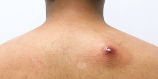 Mengapa bisul boleh tumbuh dan bagaimana merawatnya ?? 6 Cara Mengobati Bisul Secara Alami Halaman All Kompas Com