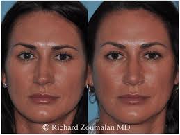 What do you need to know about nose jobs? Crooked Nose Beverly Hills Rhinoplasty