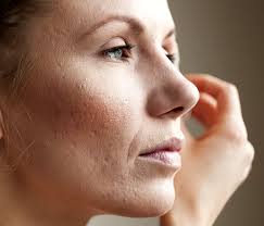 Image result for open pores,nari