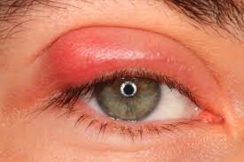 Como Curar Un Orzuelo O Chalazion Remedios Curiosfera Com