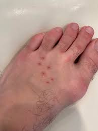 Image result for Bat Bite