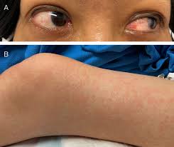 Image result for Multisystem Inflammatory Syndrome