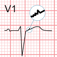 Image result for Epsilon Wave