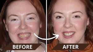 Ailidh's Smile Makeover