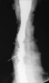 ( a from levine ms: Barium Esophagogram In Various Esophageal Diseases A Pictorial Essay Abstract Europe Pmc