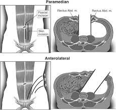Вранье инвесторам, поломки пк, всеобщий хейт. Cosmetic And Functional Outcomes Following Paramedian And Anterolateral Retroperitoneal Access In Anterior Lumbar Spine Surgery In Journal Of Neurosurgery Spine Volume 9 Issue 5 2008