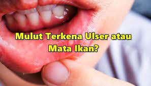 Mata ikan yang biasanya muncul di telapak kaki tentunya bisa dialami oleh siapa saja. Mulut Terkena Ulser Atau Mata Ikan Doktor Ni Kongsi Punca Rawatannya Petua Ibu