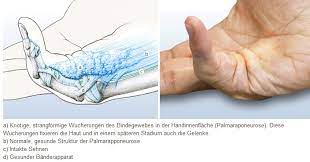 Morbus Dupuytren Wenn Sie Plotzlich Ihre Finger Nicht Mehr Strecken Konnen Hirslanden Blog