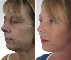 Best Treatment For Non Surgical Facelift What Are The Best Alternatives To A Surgical Facelift
