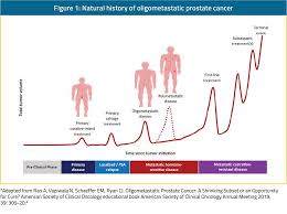 Prostate cancer metastasis occurs when cells break away from the tumor in the prostate. Oligometastatic Prostate Cancer Treatment Of The Primary Tumor And Metastasis Directed Therapy