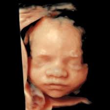 Ich weiß, je später desto größer und u.a. 3d 4d Ultraschall Praxis Fur Pranatale Diagnostik In Munchen