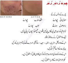 Pimples Treatment Tip In Urdu Pimple Treatment Diy Pimple Treatment Pimples