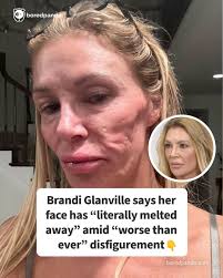 Brandi Glanville says her face has "literally melted away" amid "worse than  ever" disfigurement (link in the comments)