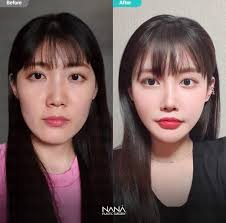 感謝客人的信任跟分享來🇰🇷韓國NaNa變美美整型過程❤️ 建議手術項目--- 1.全部輪廓三件套2.基本的鼻整形（矽膠假體+鼻中隔+耳軟骨）  福鼻矯正+