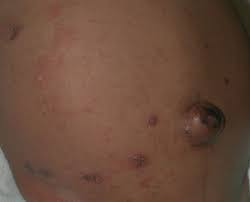 Image result for scabies human children