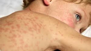 Image result for measles