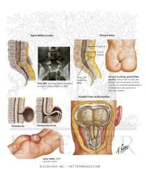 Image result for Spinal Dysraphism