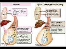 Couples with a family history of the syndrome should. Alpha 1 Antitrypsin Deficiency Youtube