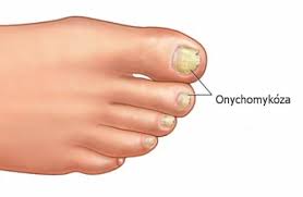 Image result for mykoza nehtů