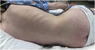 Rashes can vary in appearance greatly, and there are. A Dermatologic Perspective On Multisystem Inflammatory Syndrome In Children Sciencedirect