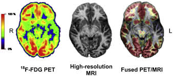 It gives detailed information about your cancer. The Future Of Pet Mri Beyond Pet Plus Mri Advances In Clinical Radiology