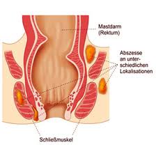 Hauptsächlich bestehen sie aus einem geflecht aus venen und arterien und formen so eine art kleines und sackförmiges kissen. Hamorrhoiden Arzt Wien Moderne Hamorrhoidenbehandlung Spezialist